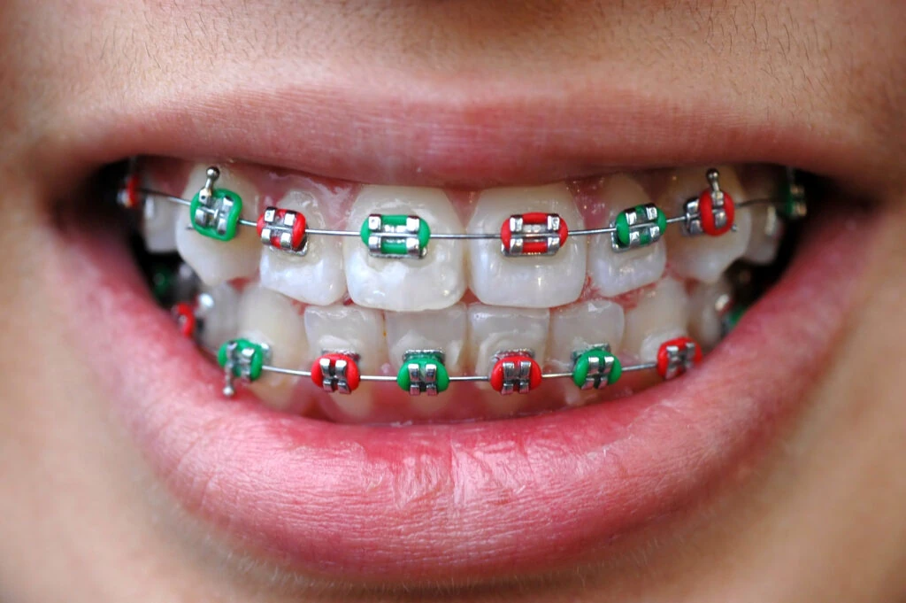 Typical unsightly steel wire braces
