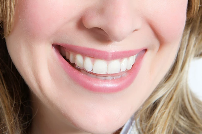 Wearing invisible braces